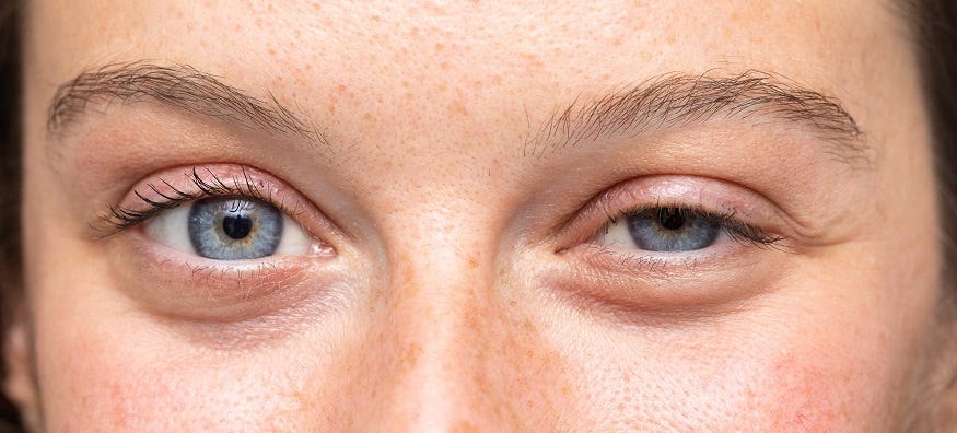 Droopy Eye Or Ptosis: Know Its Common Causes And Ultimate Treatment